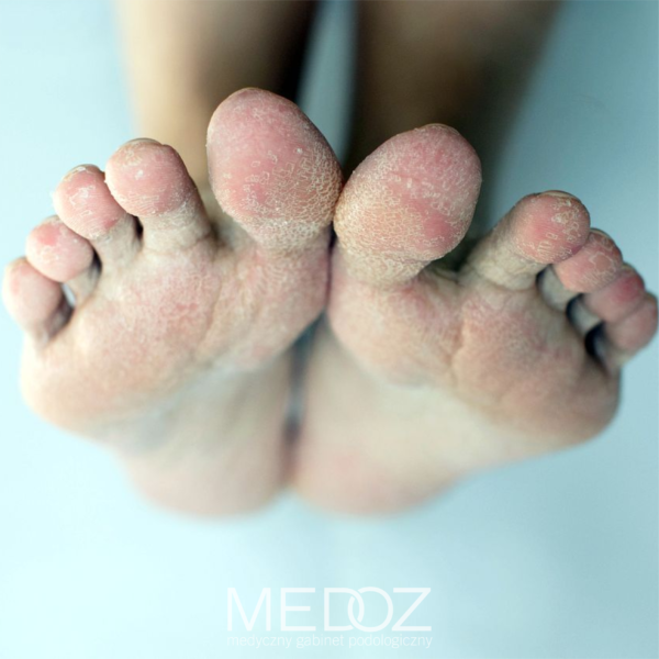MEDOZ Medyczny gabinet podologiczny bydgoszcz podolog Leczenie przerośniętych i zgrubiałych paznokci
